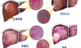 治疗肝炎需要多少钱